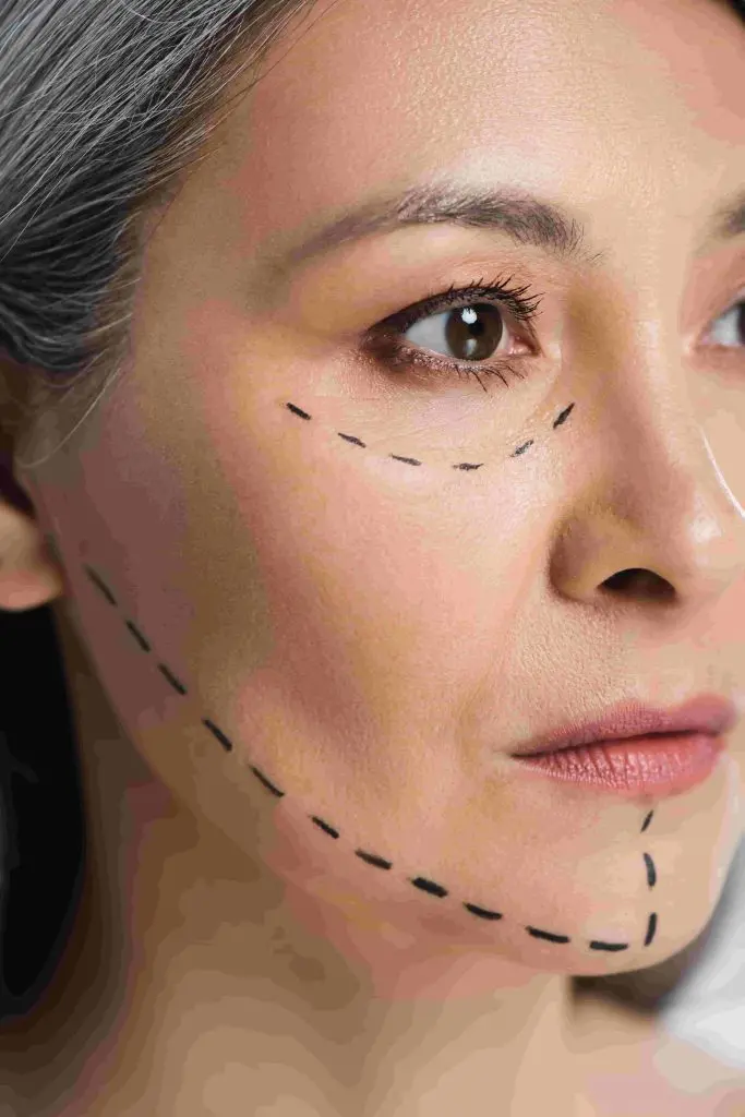 Botox for everyone